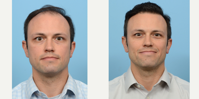 Case 8623 - 35-44 year old man treated with Hair Transplant, Hair Loss Treatment, PRP for Hair Loss, FUE Hair Transplant, NeoGraft