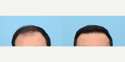 Case 8624 - 25-34 year old man treated with Hair Transplant, Hair Loss Treatment, PRP for Hair Loss, FUE Hair Transplant, NeoGraft