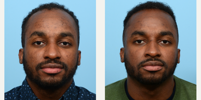 Case 8625 - 18-24 year old man treated with FUE Hair Transplant, Hair Transplant, Hair Loss Treatment, PRP for Hair Loss, NeoGraft