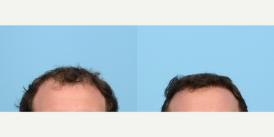 Case 8626 - 18-24 year old man treated with Hair Transplant, Hair Loss Treatment, PRP for Hair Loss, FUE Hair Transplant, NeoGraft