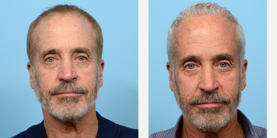 Case 8627 - 55-64 year old man treated with FUE Hair Transplant, PRP for Hair Loss, Hair Transplant, Hair Loss Treatment