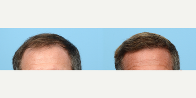 Case 8628 - 45-54 year old man treated with FUE Hair Transplant, Hair Transplant, NeoGraft, PRP for Hair Loss, Hair Loss Treatment