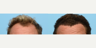 Case 8629 - 35-44 year old man treated with FUE Hair Transplant, Hair Transplant, Hair Loss Treatment, PRP for Hair Loss