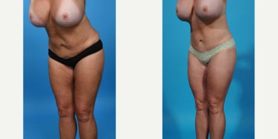 Case 863 - 35-44 year old woman treated with Tummy Tuck Revision, Mini Tummy Tuck, Drainless Tummy Tuck, Vaser Liposuction, Tummy Tuck, Dia