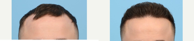 Case 8630 - 25-34 year old man treated with FUE Hair Transplant, Hair Transplant, Hair Loss Treatment, PRP for Hair Loss, NeoGraft