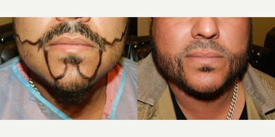Case: 8631 - before and after photo of 35-44 year old man treated with Beard Transplant by John Diep, MD