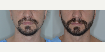 Case: 8632 - before and after photo of Man treated with Beard Transplant by Anthony Bared, MD, FACS