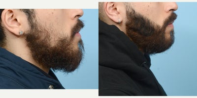 Case: 8633 - before and after photo of 18-24 year old man treated with Hair Loss Treatment by Jeffrey B. Wise, MD, FACS