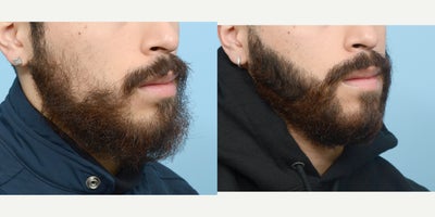 Case: 8634 - before and after photo of 18-24 year old man treated with Hair Loss Treatment by Jeffrey B. Wise, MD, FACS