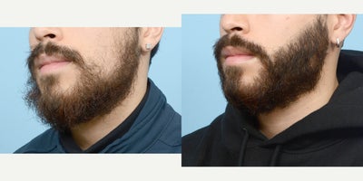 Case: 8636 - before and after photo of 18-24 year old man treated with Beard Transplant by Jeffrey B. Wise, MD, FACS
