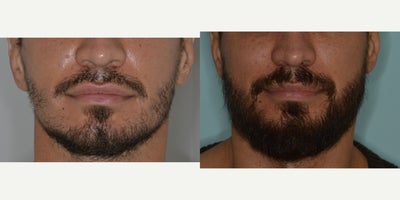 Case: 8639 - before and after photo of 35-44 year old man treated with Beard Transplant, FUE Hair Transplant by Anthony Bared, MD, FACS