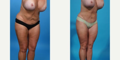 Case 864 - 35-44 year old woman treated with Tummy Tuck Revision, Mini Tummy Tuck, Drainless Tummy Tuck, Vaser Liposuction, Tummy Tuck, Dia