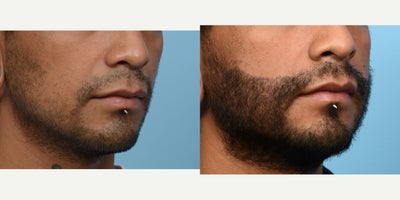 Case 8642 - 25-34 year old man treated with Hair Loss Treatment