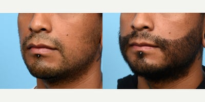 Case 8643 - 25-34 year old man treated with Hair Loss Treatment