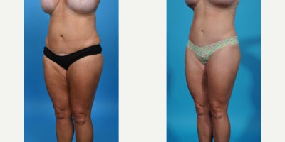 Case 865 - 35-44 year old woman treated with Tummy Tuck Revision, Mini Tummy Tuck, Drainless Tummy Tuck, Vaser Liposuction, Tummy Tuck, Dia