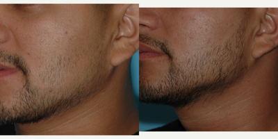 Case 8652 - 25-34 year old man treated with SmartGraft Hair Transplant to the beard for hypotrichia