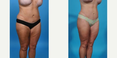 Case 866 - 35-44 year old woman treated with Tummy Tuck Revision, Mini Tummy Tuck, Drainless Tummy Tuck, Vaser Liposuction, Tummy Tuck, Dia