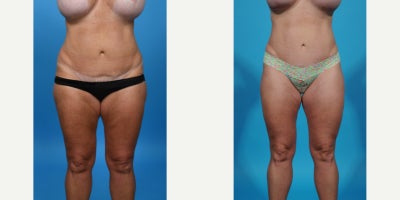 Case 867 - 35-44 year old woman treated with Tummy Tuck Revision, Mini Tummy Tuck, Drainless Tummy Tuck, Vaser Liposuction, Tummy Tuck, Dia