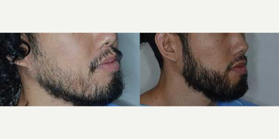 Case 8670 - Man treated with Beard Transplant