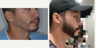 Case 8673 - Male patient treated with 1800 FUE Beard Transplant