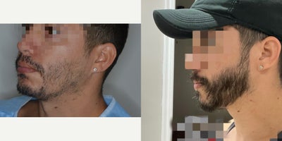 Case 8674 - Male patient treated with 1800 FUE Beard Transplant