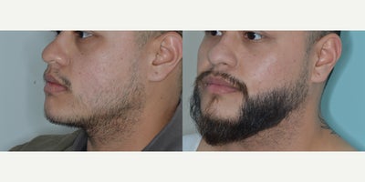 Case 8675 - 25-34 year old man treated with FUE Hair Transplant, Beard Transplant