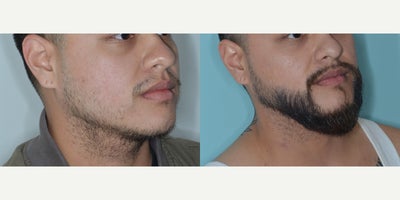 Case 8676 - 25-34 year old man treated with FUE Hair Transplant, Beard Transplant