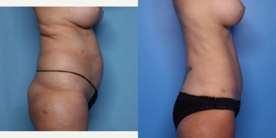 Case 868 - 45-54 year old woman treated with Tummy Tuck