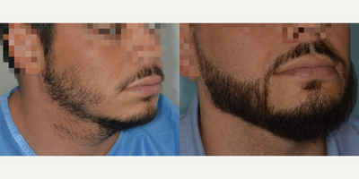 Case 8687 - 35-44 year old man treated with Beard Transplant