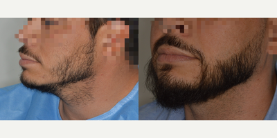 Case 8688 - 35-44 year old man treated with Beard Transplant