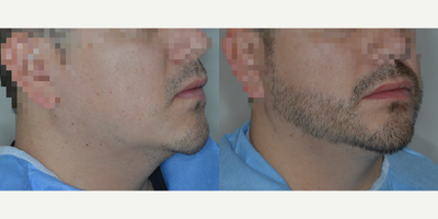 Case 8689 - Man treated with Beard Transplant