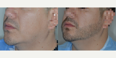 Case 8690 - Man treated with Beard Transplant