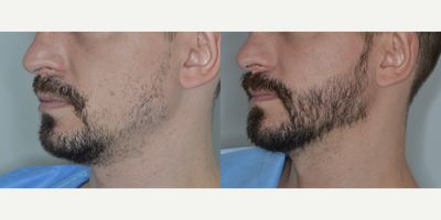 Case 8691 - Man treated with Beard Transplant