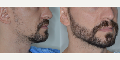 Case 8692 - Man treated with Beard Transplant