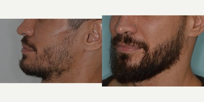 Case 8693 - 35-44 year old man treated with Beard Transplant, FUE Hair Transplant