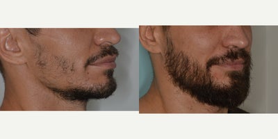 Case 8694 - 35-44 year old man treated with Beard Transplant, FUE Hair Transplant