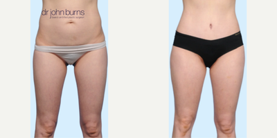 Case 87 - Woman treated with Tummy Tuck