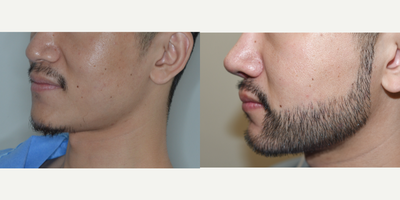 Case 8701 - 25-34 year old man treated with Beard Transplant