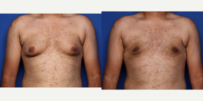 Case: 8749 - before and after photo of 18-24 year old man treated with Gynecomastia Surgery by Naveen Setty, MD
