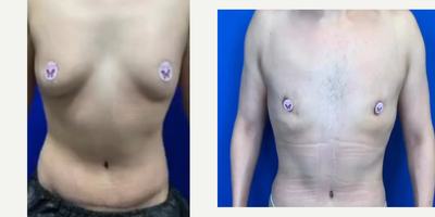 Case: 8750 - before and after photo of Man treated with Gynecomastia Surgery by Urmen Desai, MD, MPH, FACS