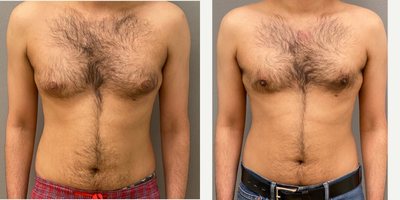 Case: 8751 - before and after photo of 25-34 year old man treated with Gynecomastia Surgery by Keshav Magge, MD