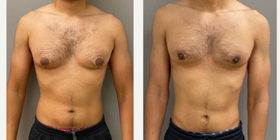 Case: 8752 - before and after photo of 18-24 year old man treated with Gynecomastia Surgery by Keshav Magge, MD
