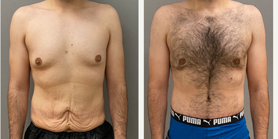 Case: 8753 - before and after photo of 25-34 year old man treated with Gynecomastia Surgery, Male Tummy Tuck by Keshav Magge, MD