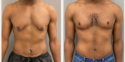 Case: 8754 - before and after photo of 25-34 year old man treated with Male Tummy Tuck, Gynecomastia Surgery, Masculinizing Top Surgery by Keshav Magge, MD