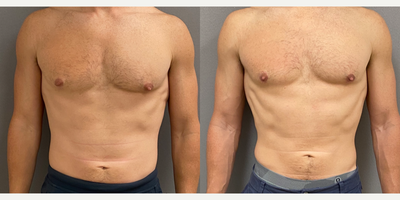 Case: 8755 - before and after photo of 35-44 year old man treated with Gynecomastia Surgery by Keshav Magge, MD