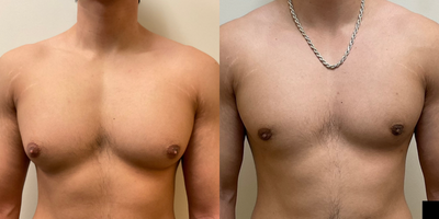 Case: 8756 - before and after photo of Man treated with Gynecomastia Surgery by David Liland, MD