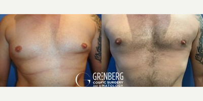 Case: 8757 - before and after photo of Woman treated with Gynecomastia Surgery by Stephen T. Greenberg, MD, FACS