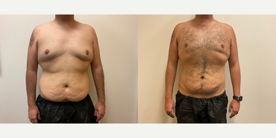 Case 8759 - Man treated with Gynecomastia Surgery