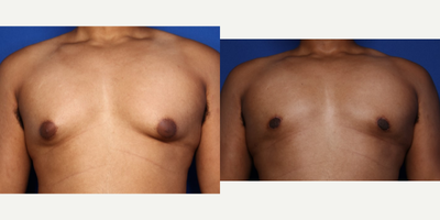 Case 8762 - 18-24 year old man treated with Gynecomastia Surgery