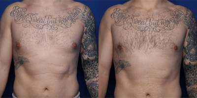 Case 8766 - 25-34 year old man treated with Gynecomastia Surgery
